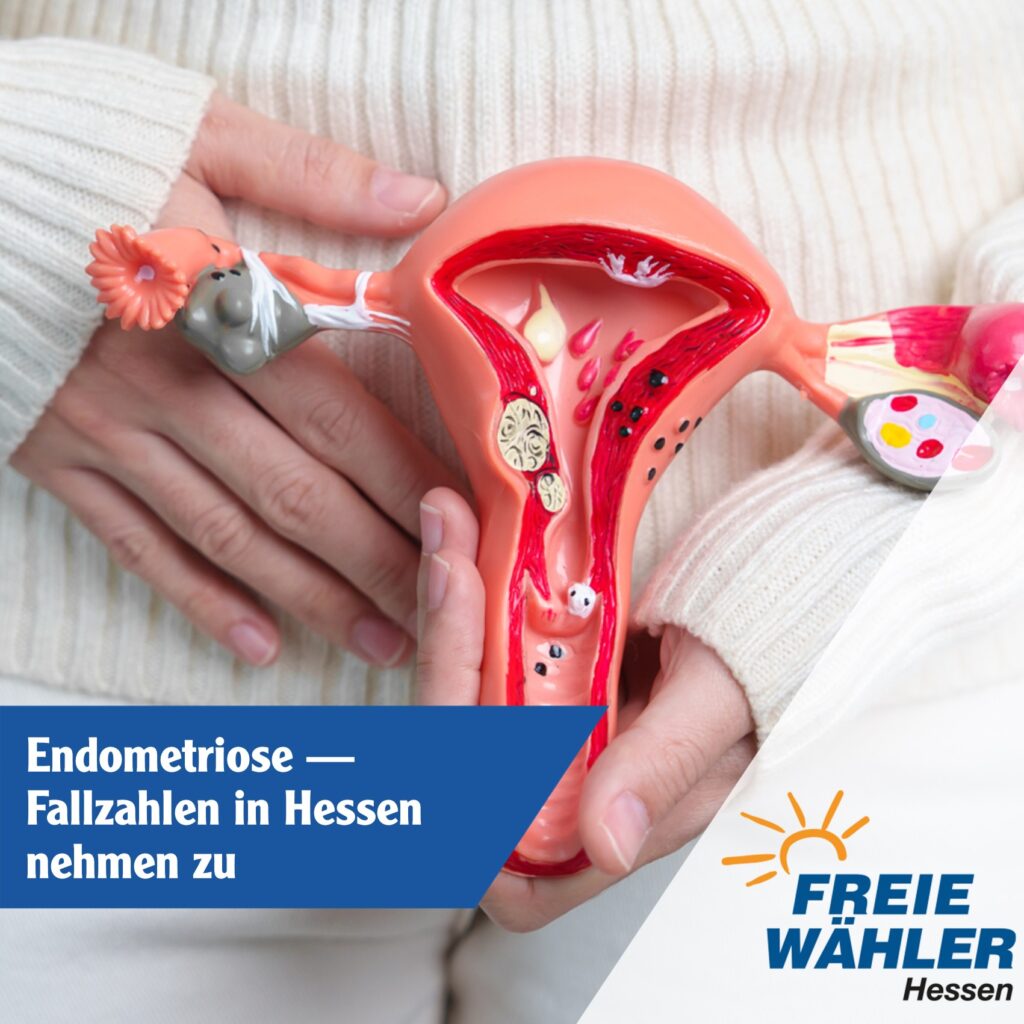 Endometriose – Fallzahlen in Hessen nehmen zu